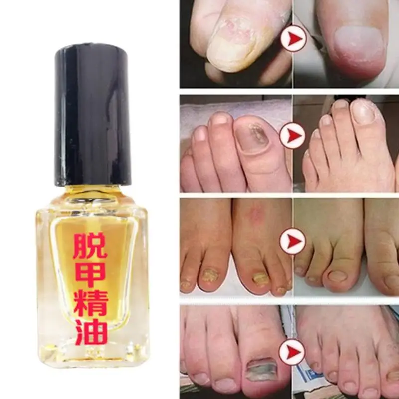 boala fungică a unghiilor și picioarelor puroi pe unghia ciupercii mâinii